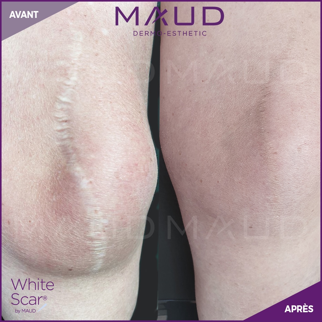Avant-Apres-white-scar